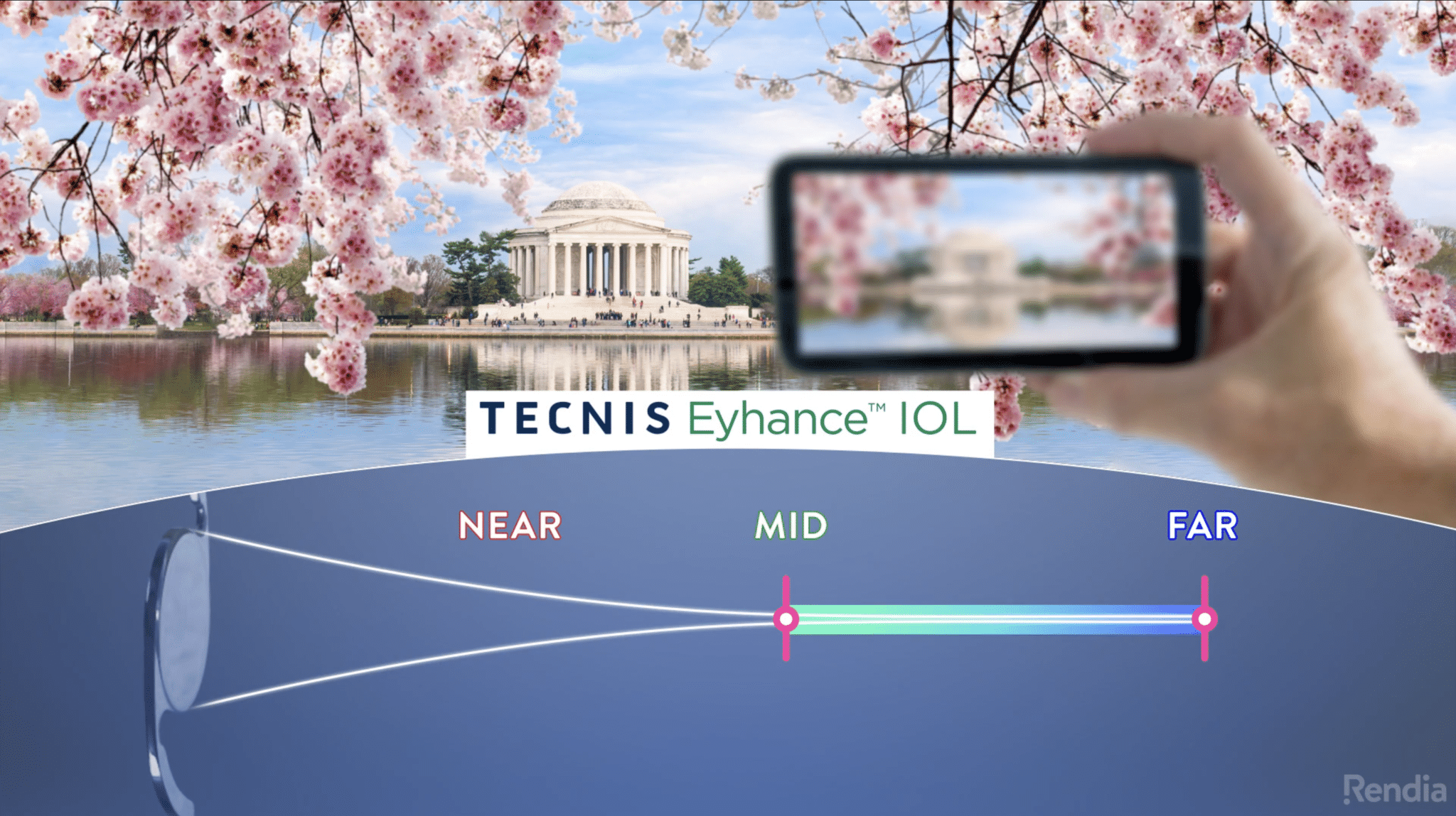 Enhanced Iol Cataract Surgery Toronto | Premium Lens Implants North York