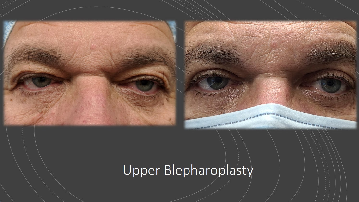 Eyelid Surgery Toronto | Blepharoplasty Toronto | North Toronto Eye Care