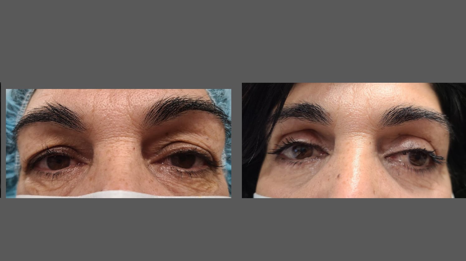 Eyelid Surgery Toronto | Blepharoplasty Toronto | North Toronto Eye Care