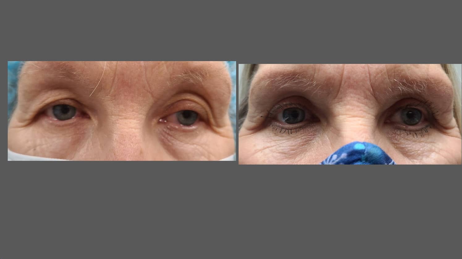 Eyelid Surgery Toronto | Blepharoplasty Toronto | North Toronto Eye Care