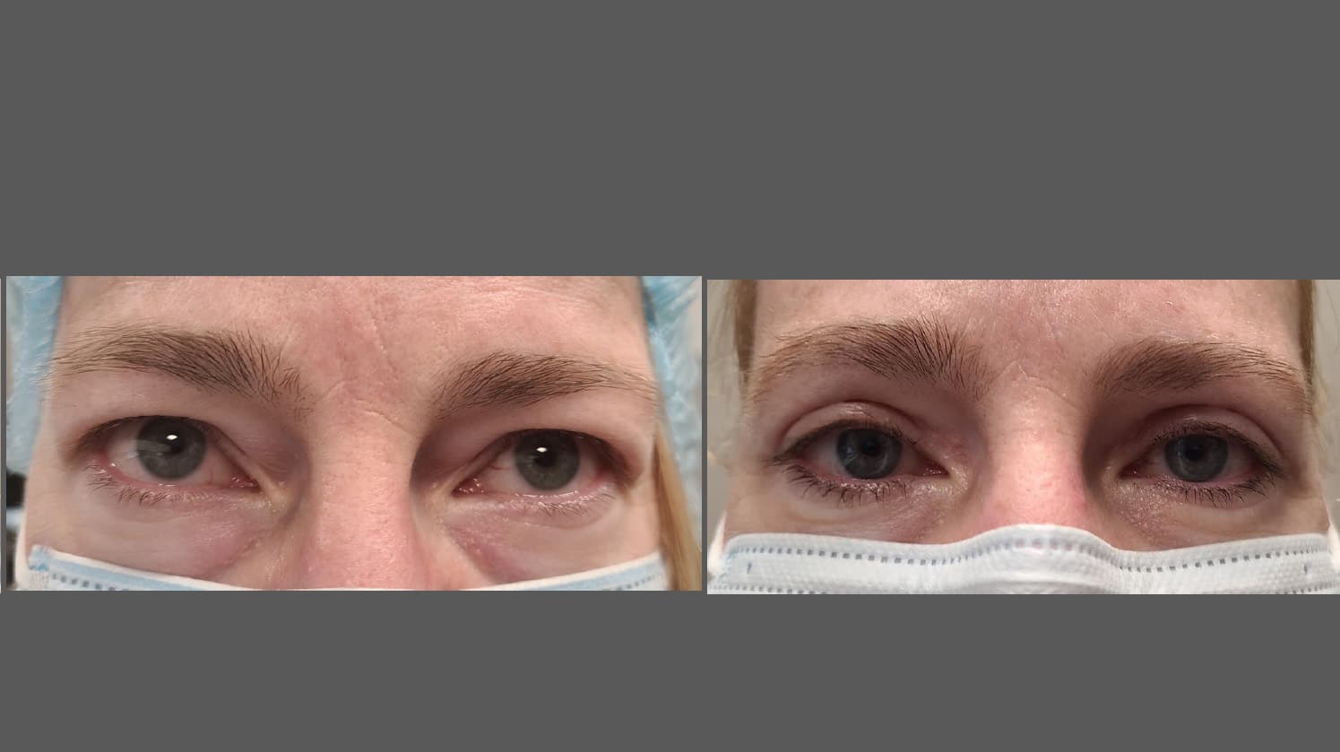 Eyelid Surgery Toronto | Blepharoplasty Toronto | North Toronto Eye Care