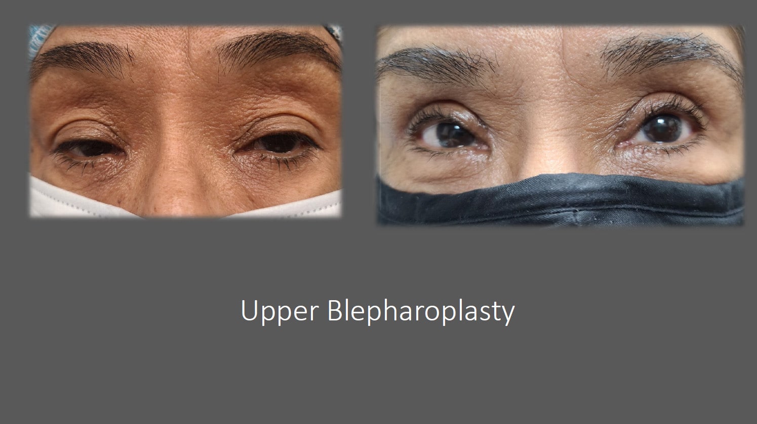 Toronto Eyelid Surgery : Eyelid Surgery Blepharoplasty in Toronto ...