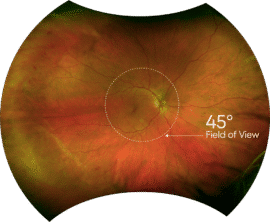 Technology Spotlight: OPTOS Imaging in Modern Retinal Care